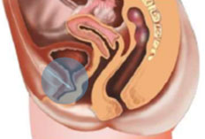 prolapso-uterino